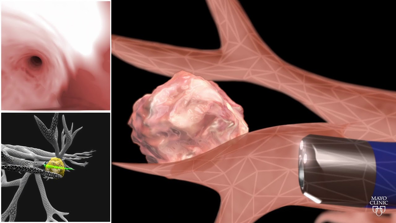 Mayo Clinic Minute: How robotic assisted bronchoscopy helps patients