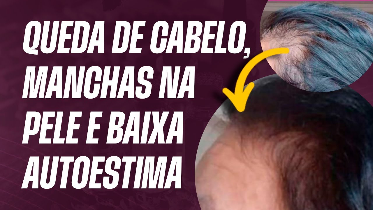 Queda de cabelo, manchas na pele e baixa autoestima? Vire o jogo de forma natural