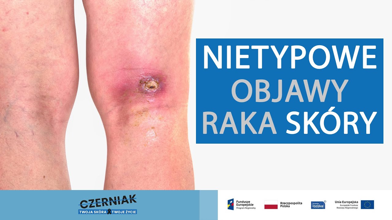 Na jakie zmiany sk&oacute;rne zwr&oacute;cić uwagę? Nietypowe objawy raka sk&oacute;ry