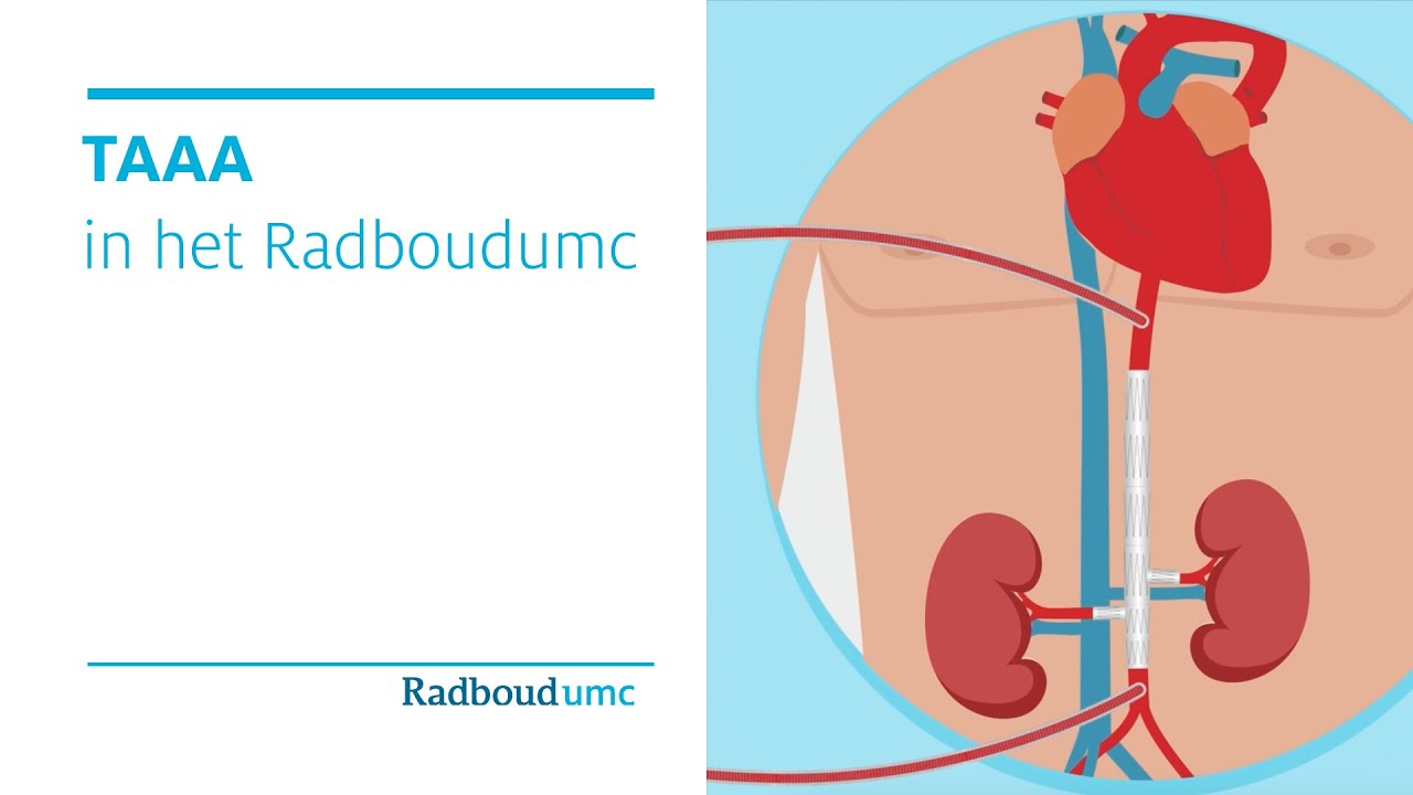 TAAA – aneurysma in de borst- en buikholte