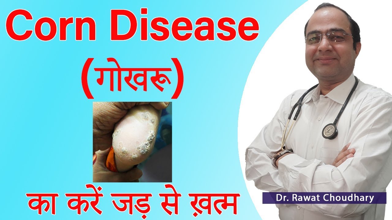 Corn Disease | गोखरू | गट्ठा | Foot Corn Best Treatment | Best Homeopathic Doctor