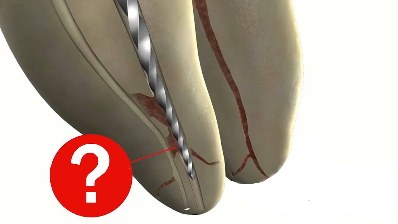 Эндодонтия - техника краун даун, торсионная, циклическая нагрузки, формирование доступа