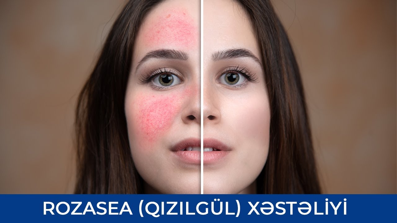 ROZASEA (Qızılg&uuml;l) Xəstəliyi - Quba R&uuml;stəmova (Dermatoveneroloq - kosmetoloq )