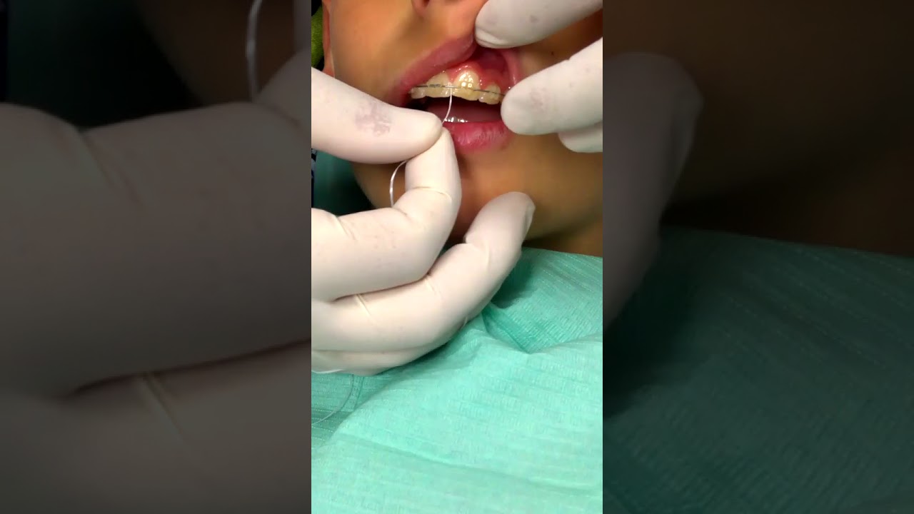 Come usare il filo interdentale con l’apparecchio ortodontico