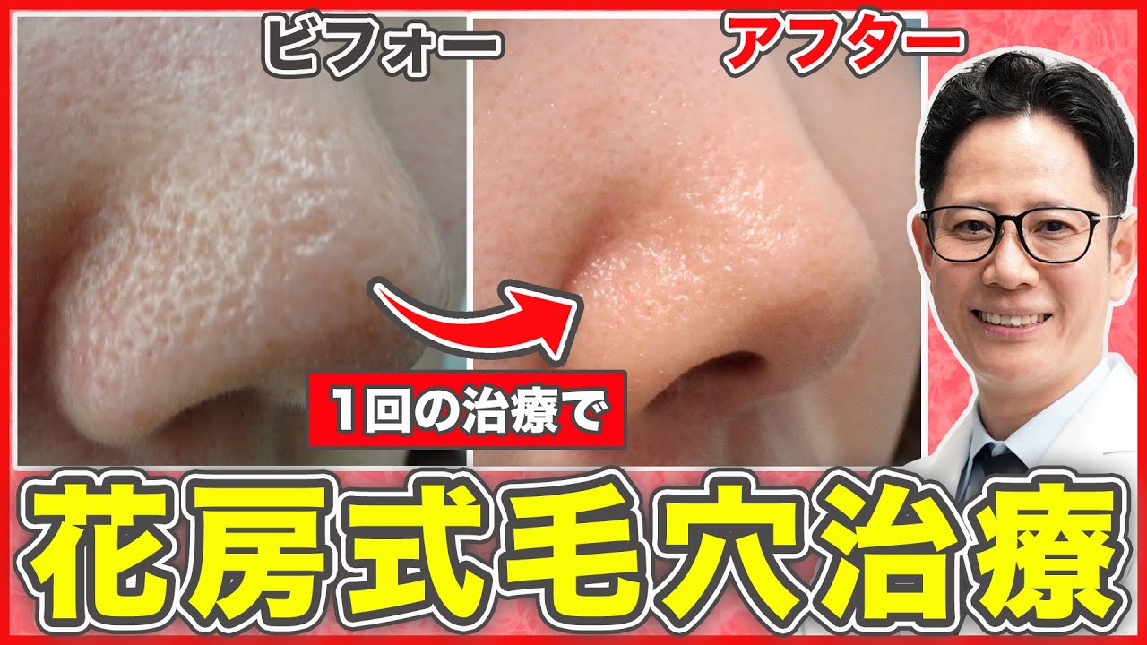 【いちご鼻】最終兵器