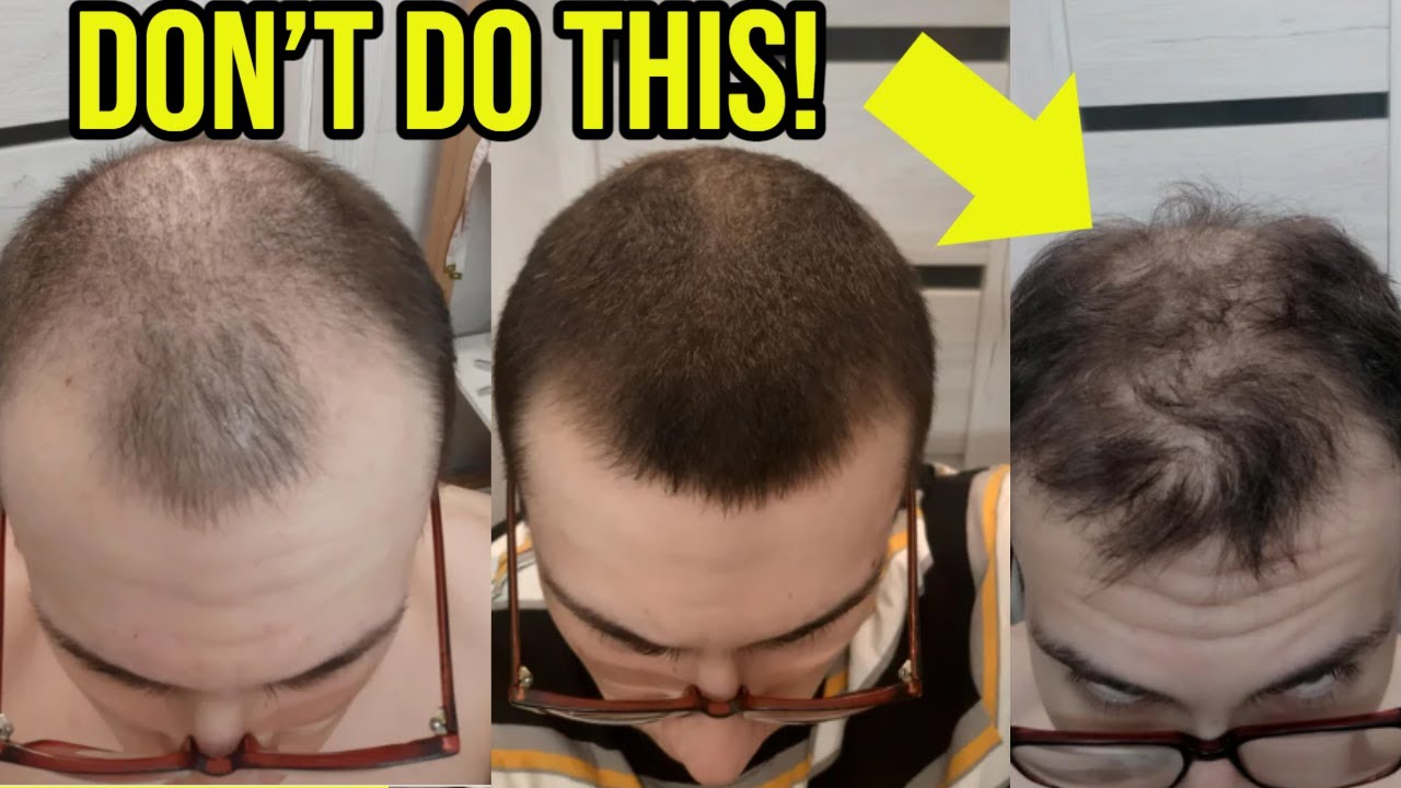 THE #1 THING YOU SHOULD NEVER DO WHILE ON HAIR LOSS TREATMENT! (WARNING)