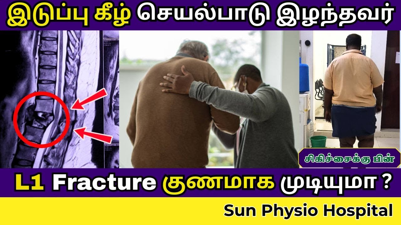 L1 spine Fracture Recovery | நடக்க முடியாதவர் மீண்டும் நடப்பது எப்படி? Explain In Tamil Sun Hospital
