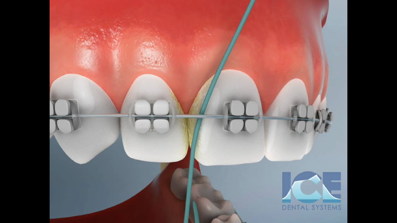 Flossing With Braces
