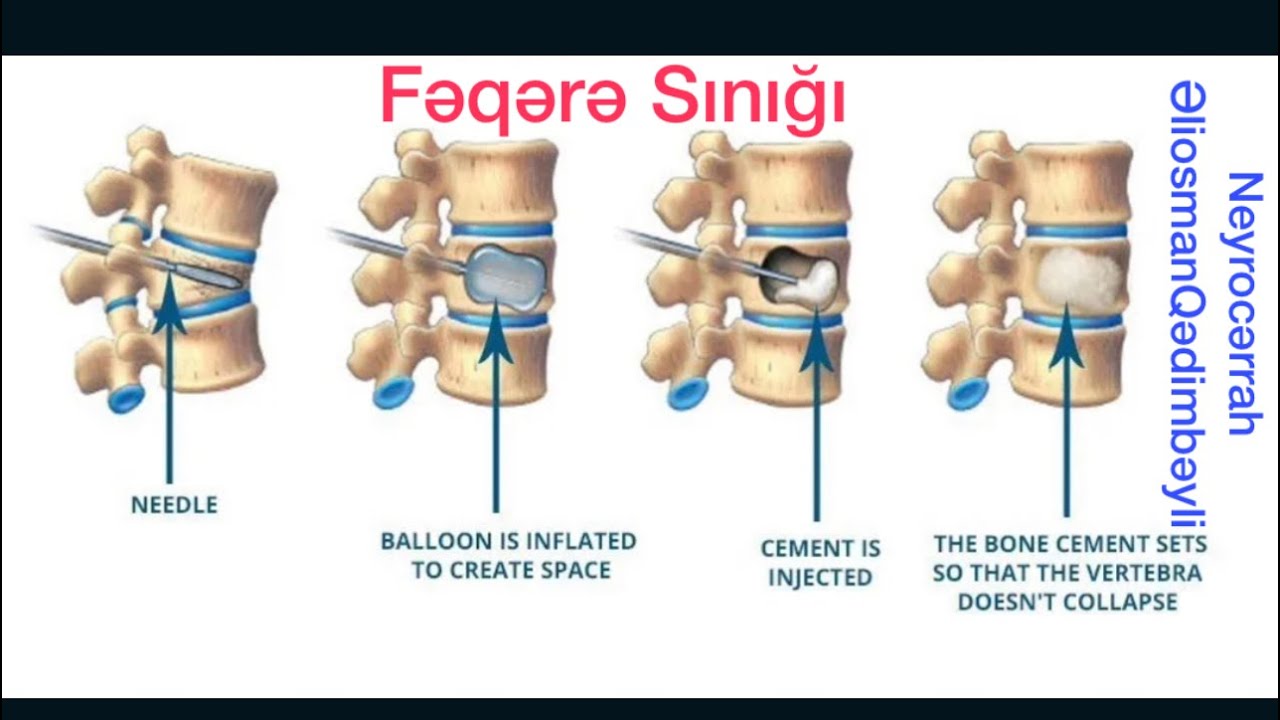 Onurğa sınığı,fəqərə sınığı,bel sınığı əməliyyatı.Vertebroplastika.Neyrocərrah Əliosman Qədimbəyli