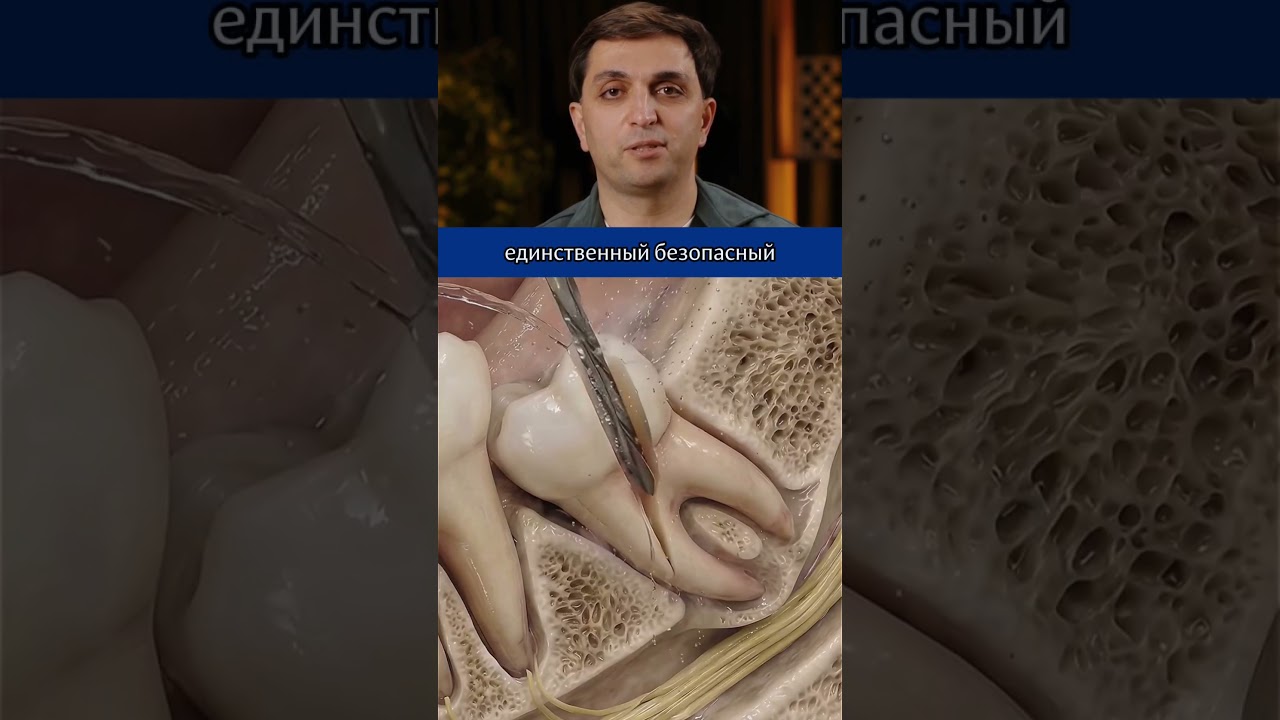 Зачем разрезают зуб мудрости?