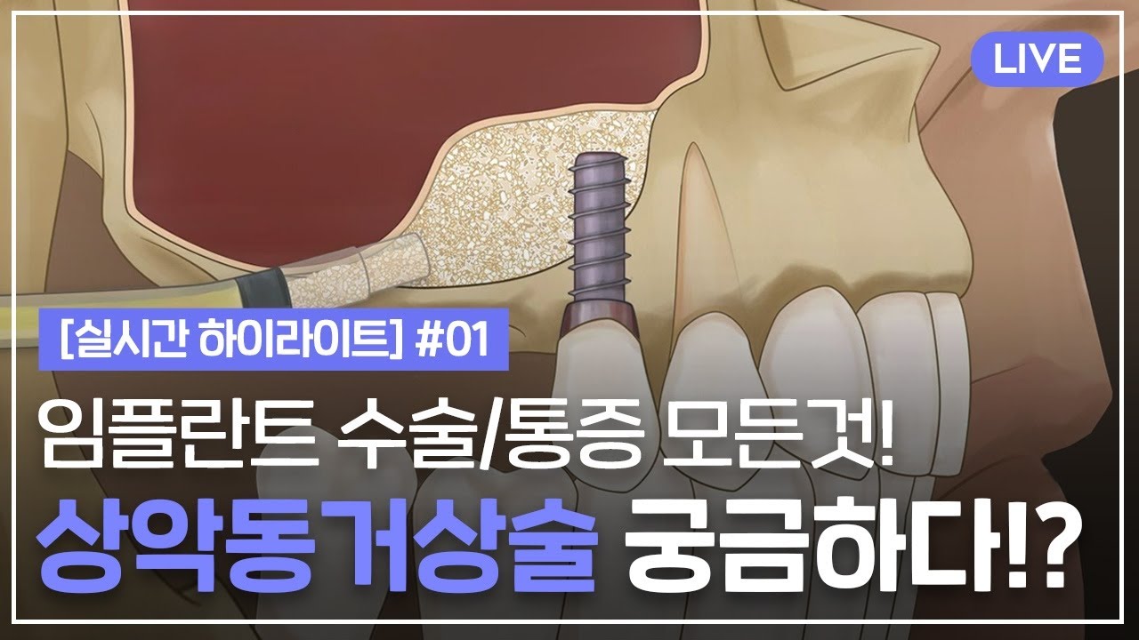 [실시간 하이라이트] 임플란트 A부터 Z까지❗️❗️ 상악동거상술/수술/과정/통증 궁금하면 드루와~드루와~~💡 EP-01