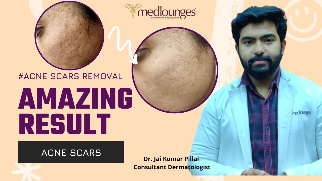 HOW TO GET RID OF ACNE SCARS FAST