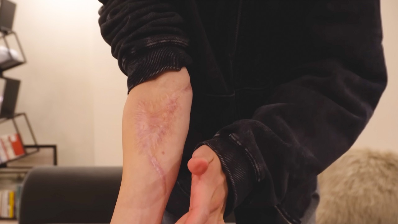 お医者さんに「最悪腕無くなります」って言われたガジェット系YouTuberの話