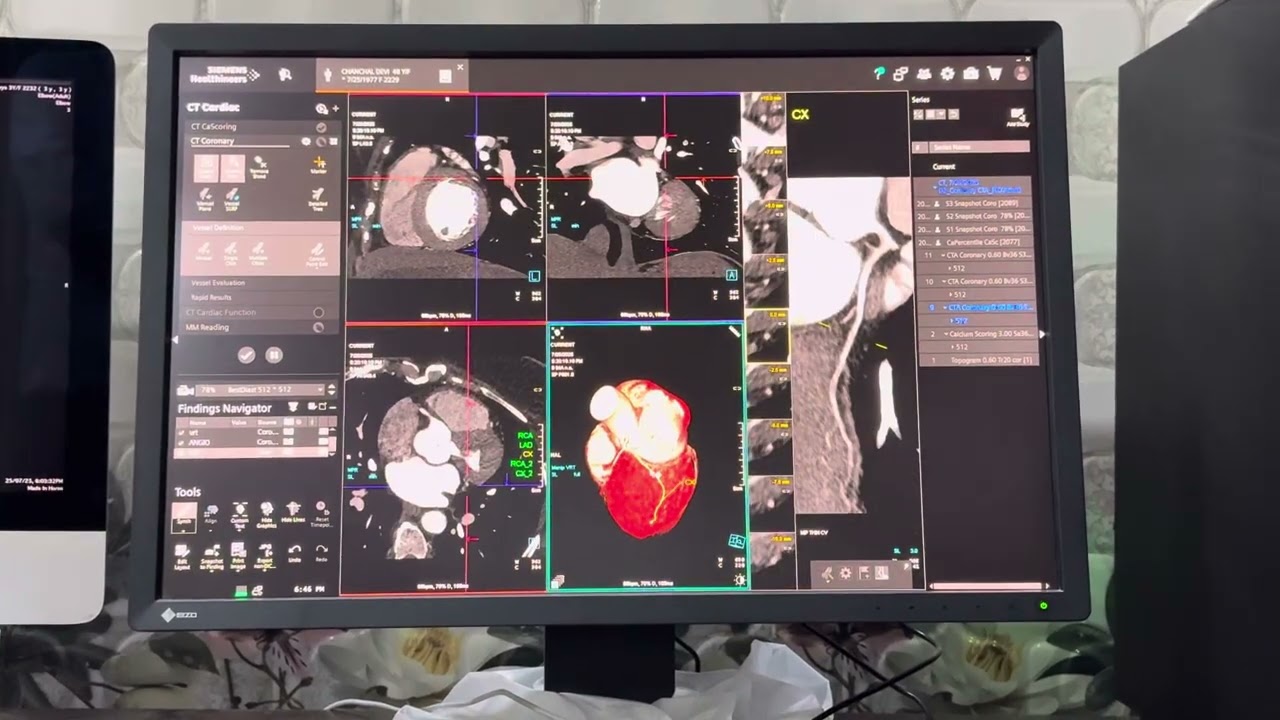 CT Coronary angio filming and post processing in synoviaya Siemens CT GO TOP