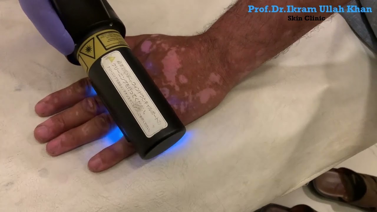 Vitiligo Got You Stressed? This Laser Treatment RESTORES Skin Color! #vitiligo #lasertreatment