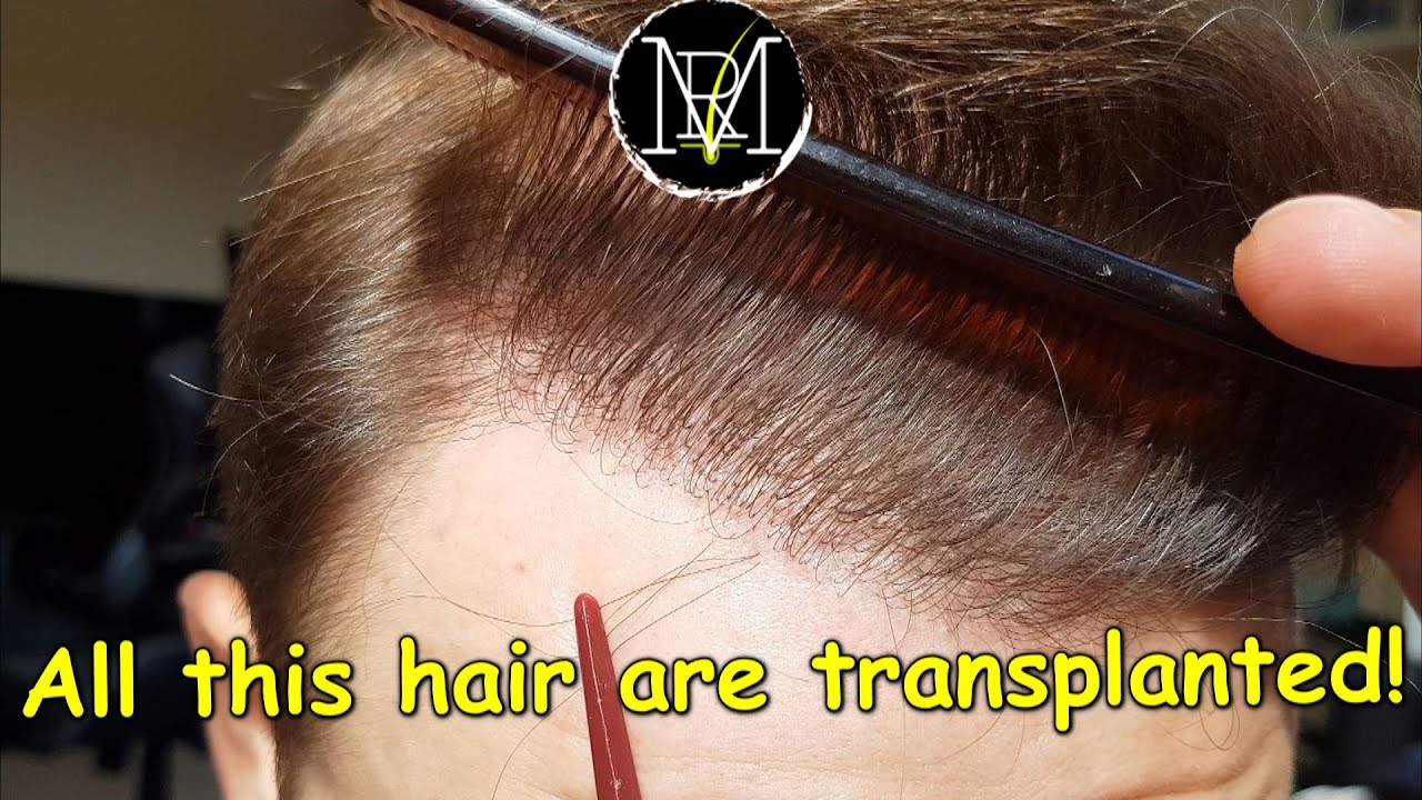 I'm MAD! 7.5 Months after FUE Hair Transplant | 3500 grafts