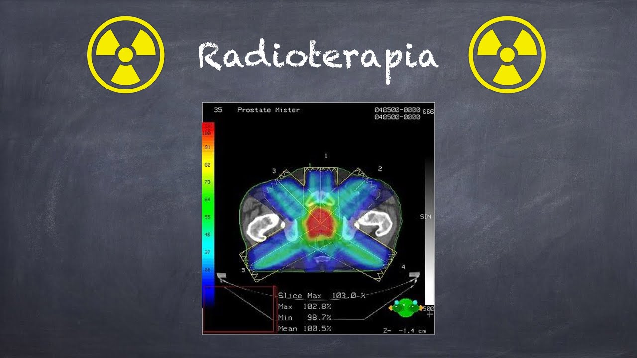 Radioterapia