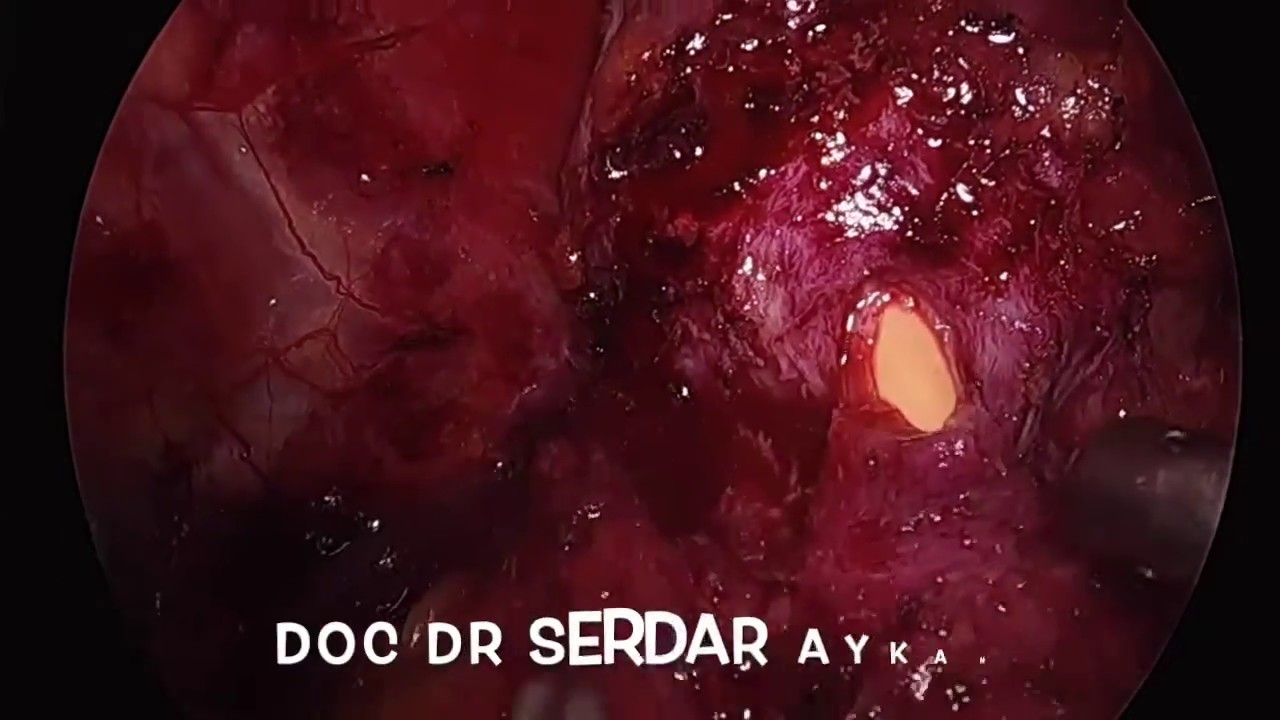 SA-53 laparoscopic radical prostatectomy - bladder neck sparing - Serdar Aykan MD Assoc Prof