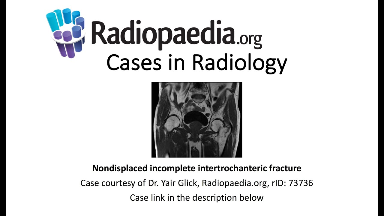 Nondisplaced incomplete intertrochanteric fracture (Radiopaedia.org) Cases in Radiology