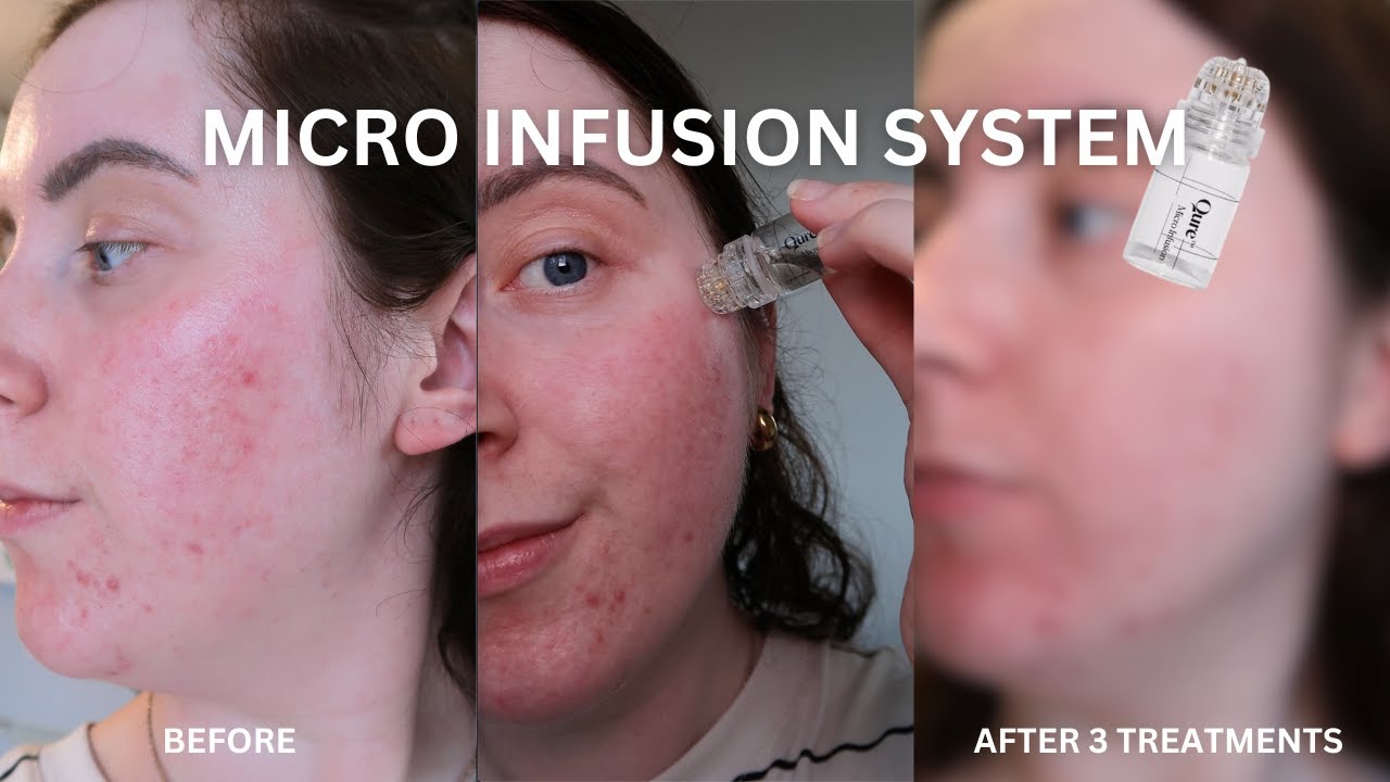 AD | 6 Weeks of Qure Skincare | Dark Spots & uneven Skin Tone | Before & After