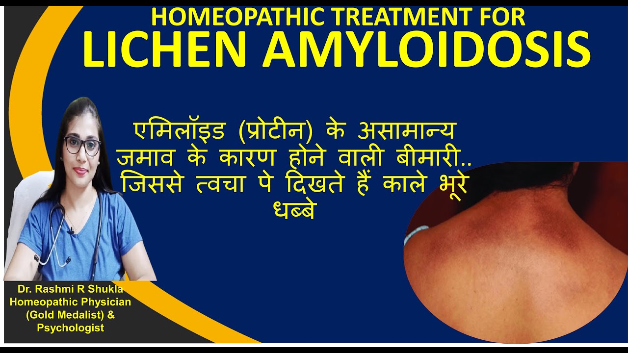 Lichen Amyloidosis Homeoapthic Treatment|त्वचा पर भूरे धब्बे देने वाली इस जिद्दी बीमारी का ईलाज