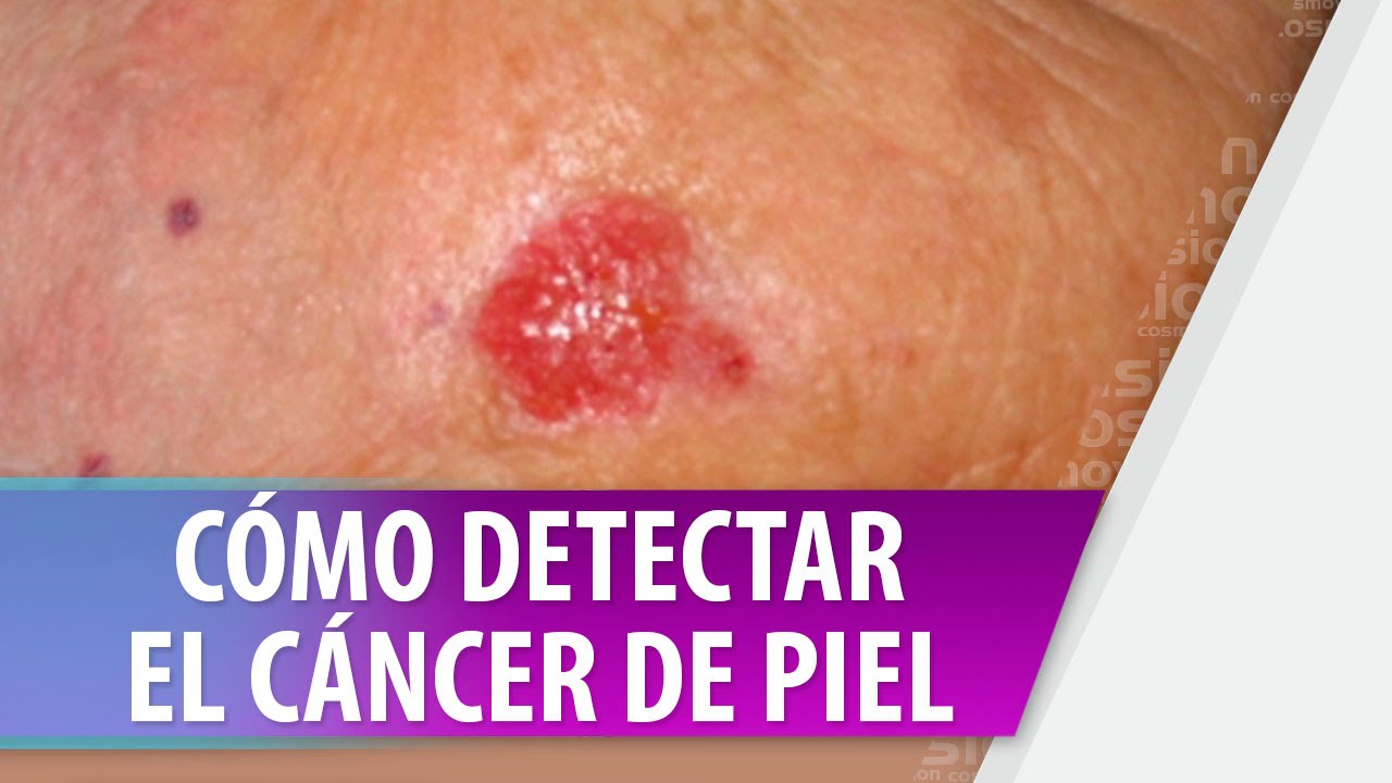 Como detectar cancer de piel