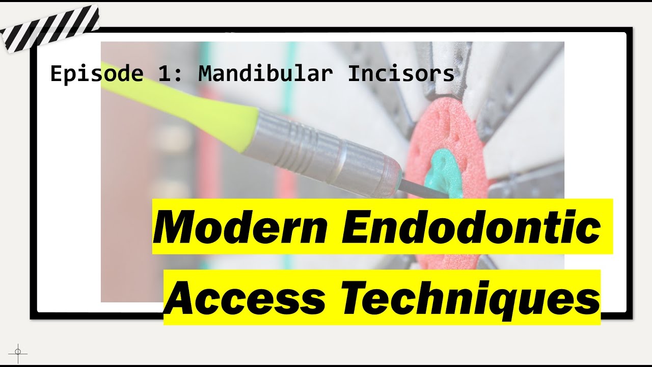 Modern Endodontic Accesses: Mandibular Incisors
