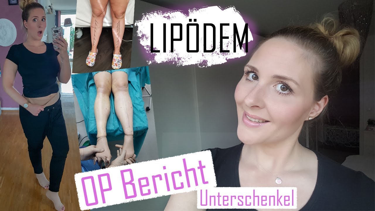 Lipödem | OP Bericht | Meine Unterschenkel-OP | LipoClinic | Teil 1
