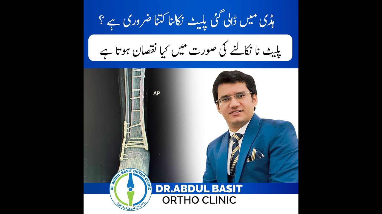 ہڈی میں ڈالی پلیٹ یا راڈ کب نکلوانی چاہیے ؟ when to remove plate and Rod in Bones | Dr.Abdul Basit