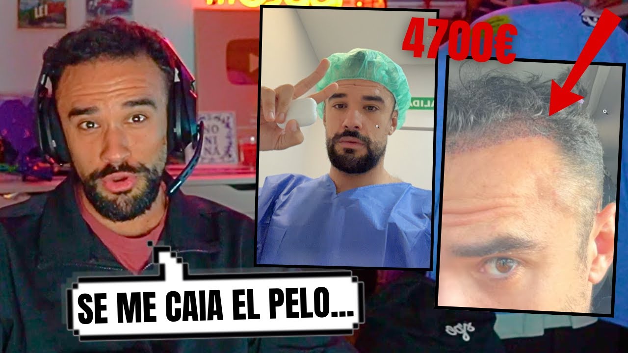 Así Fue la EXPERIENCIA de ILLOJUAN Poniendose PELO | Implante Capilar