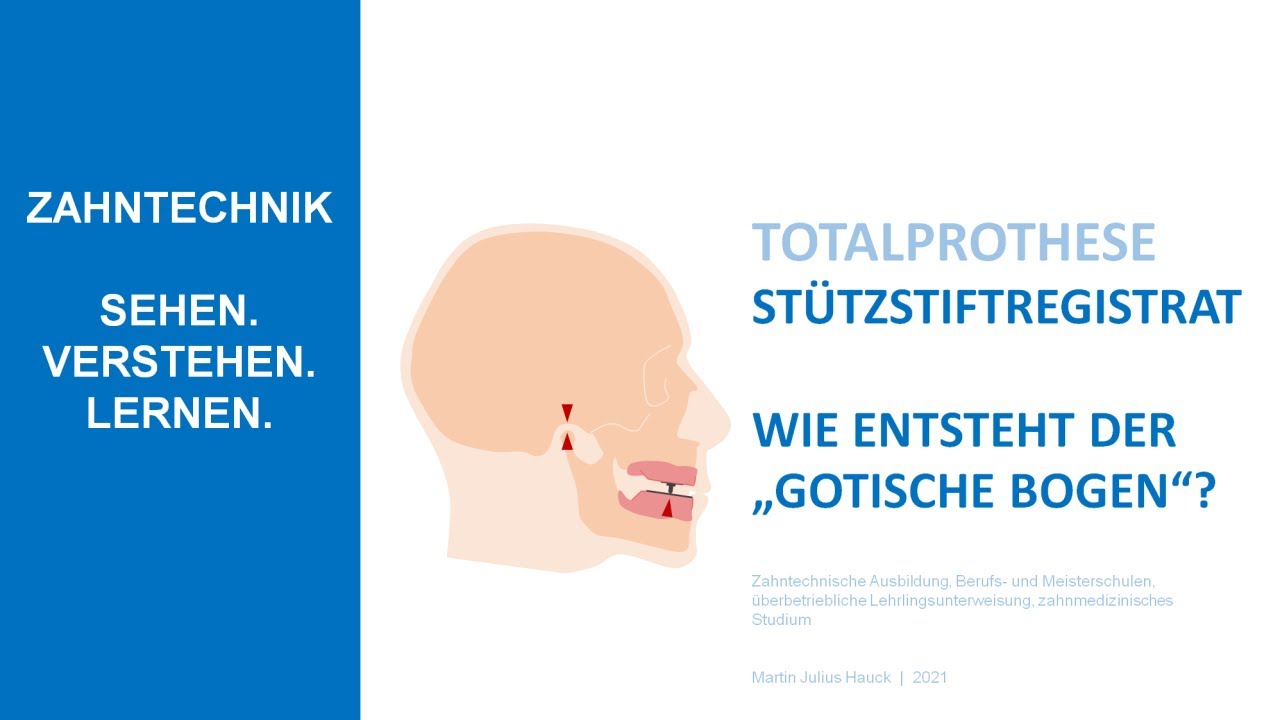 Totalprothese Stützstiftregistrat nach Gerber