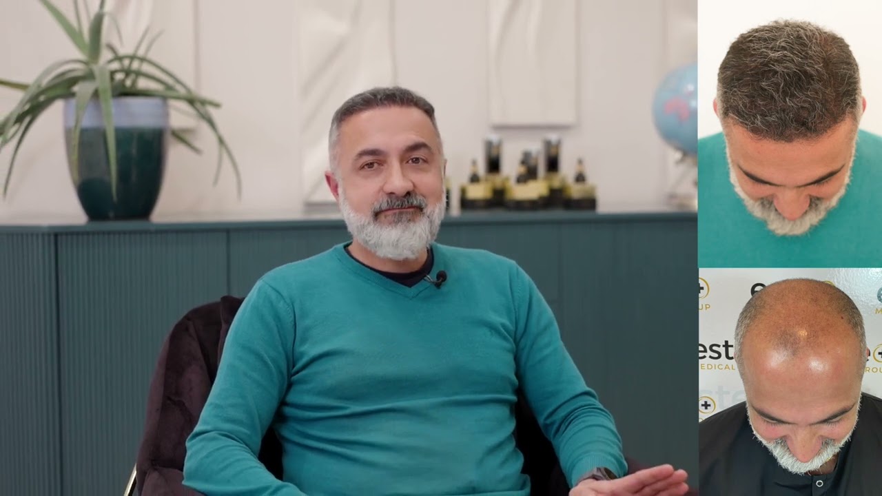 Arash's Remarkable Hair Transplant Journey | 5-Month Check-In at Este Medical Leeds