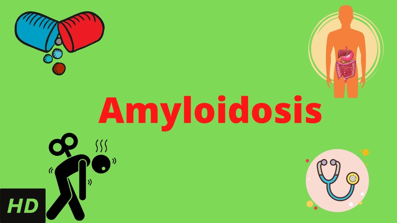 Amyloidosis, Causes, Signs and Symptoms, Diagnosis and Treatment.