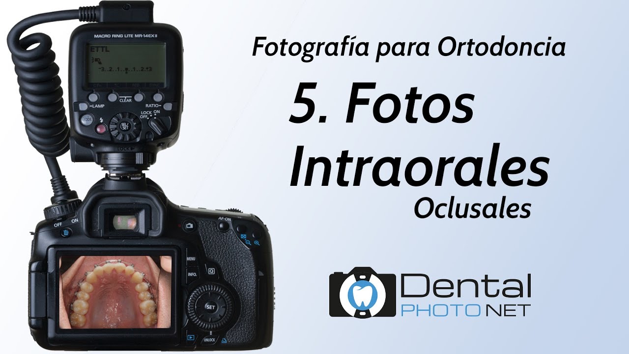 Fotografía para Ortodoncia. 5- Fotos Intraorales (Oclusales)