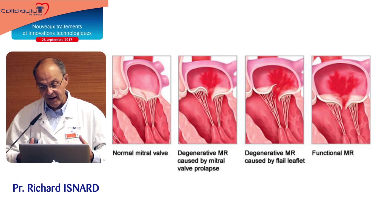 01 - Le MitraClip® : pour quels patients ?