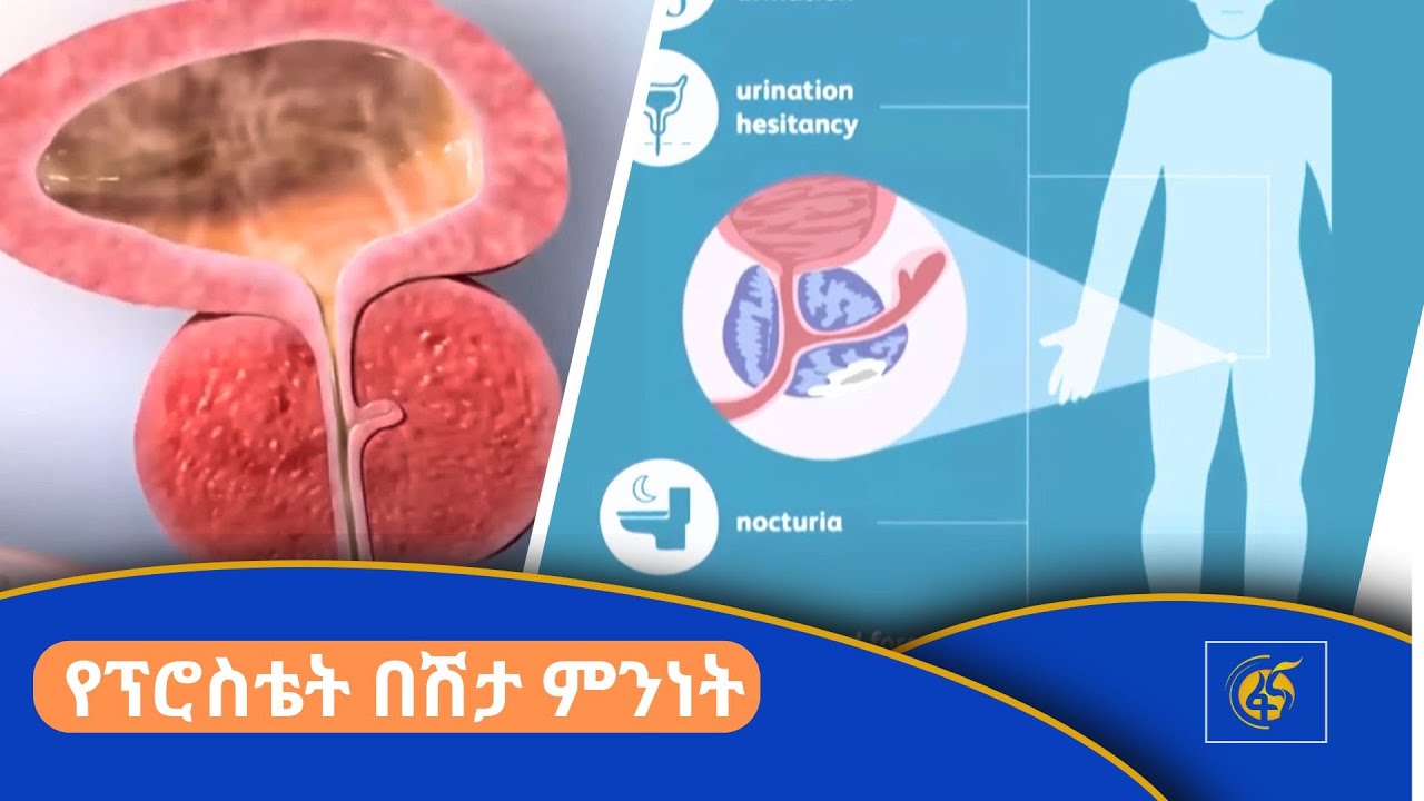 የፕሮስቴት በሽታ ምንነት
