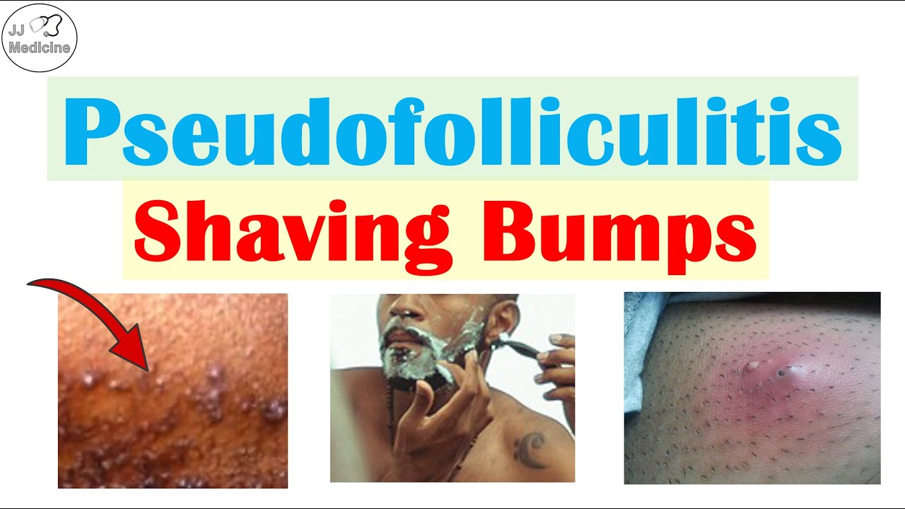 Pseudofolliculitis Barbae & Pubis (Shaving/Razor Bumps): Causes, Complications, Treatment