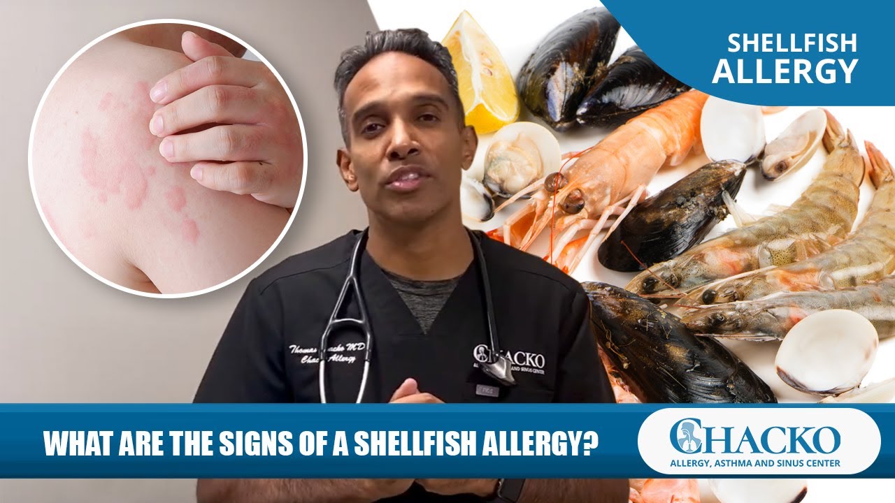 What Are the Signs of a Shellfish Allergy? [Chacko Allergy]