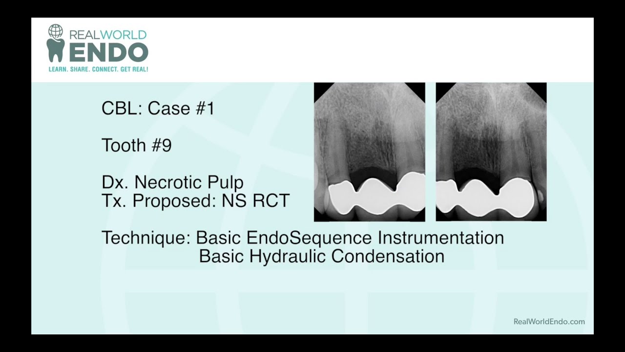 CBL #1 Anterior Tooth Endodontics