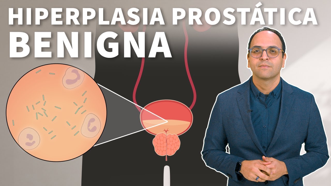 Hiperplasia prostática benigna: Como afecta a los hombres? (HPB) | Stanford
