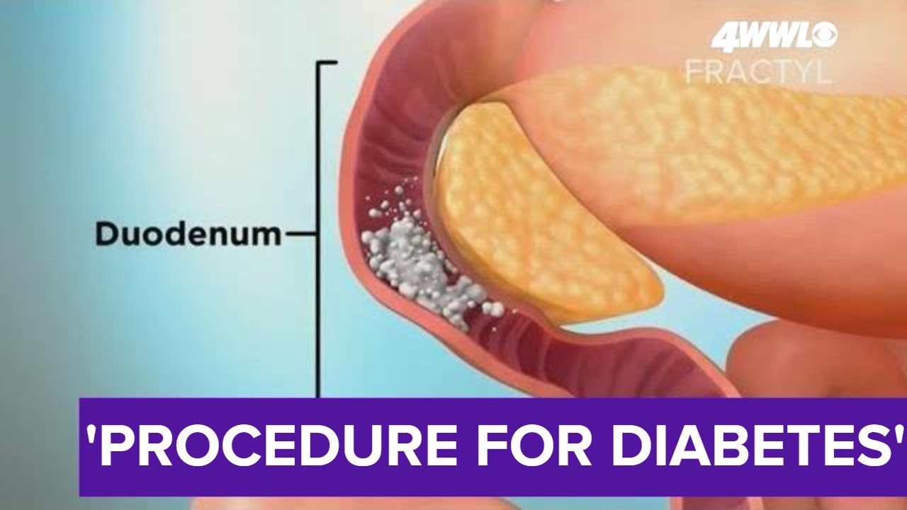 New study procedure for Type 2 diabetes
