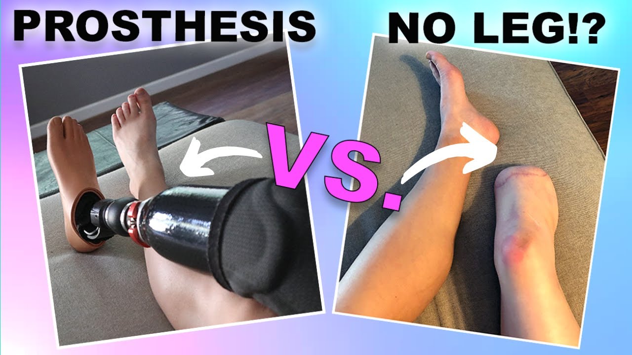 How Long Do Amputees Wear Prosthetics For Each Day??