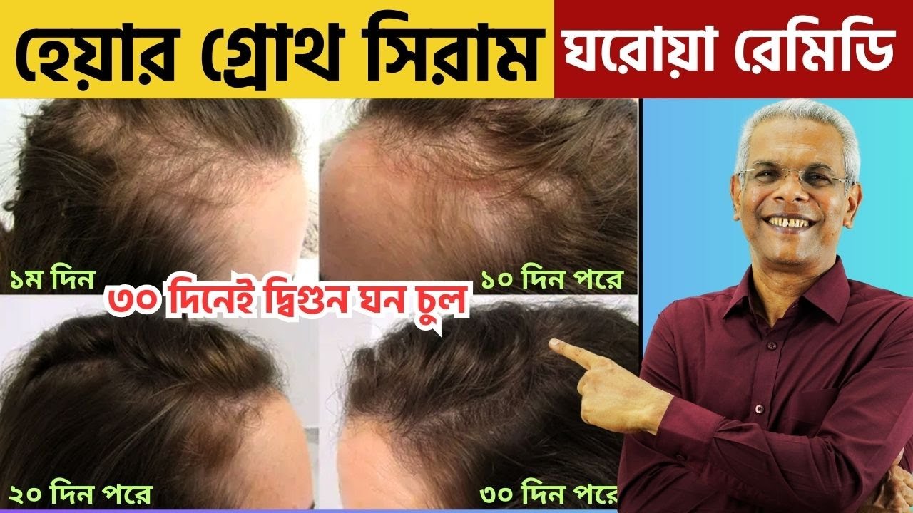 ৩০ দিনেই হারানো চুল পুনরায় গজাবে এবং দ্বিগুণ ঘন হবে ! শক্তিশালী চুল বৃদ্ধির সিরাম। Hair Growth