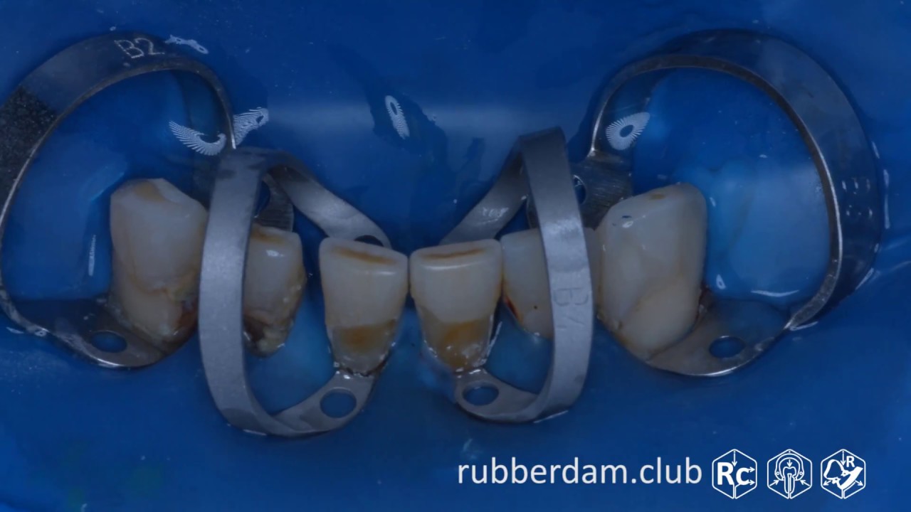 Установка системы раббердам 4.3 - 3.3 (Rubberdam 153 TorVM Brinker B4 4K) Ч. 1 из 4 - Апокин А.Д.