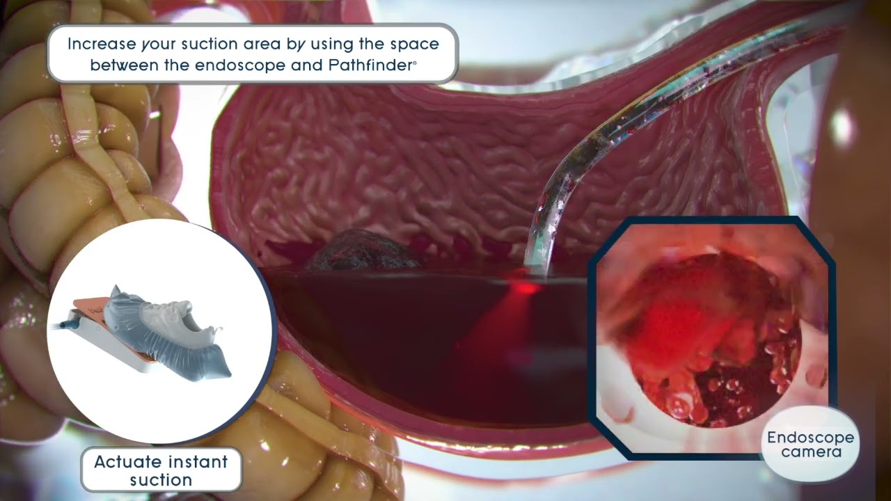 PathfinderCR  Removes Upper GI Blood Clots with Total Control.