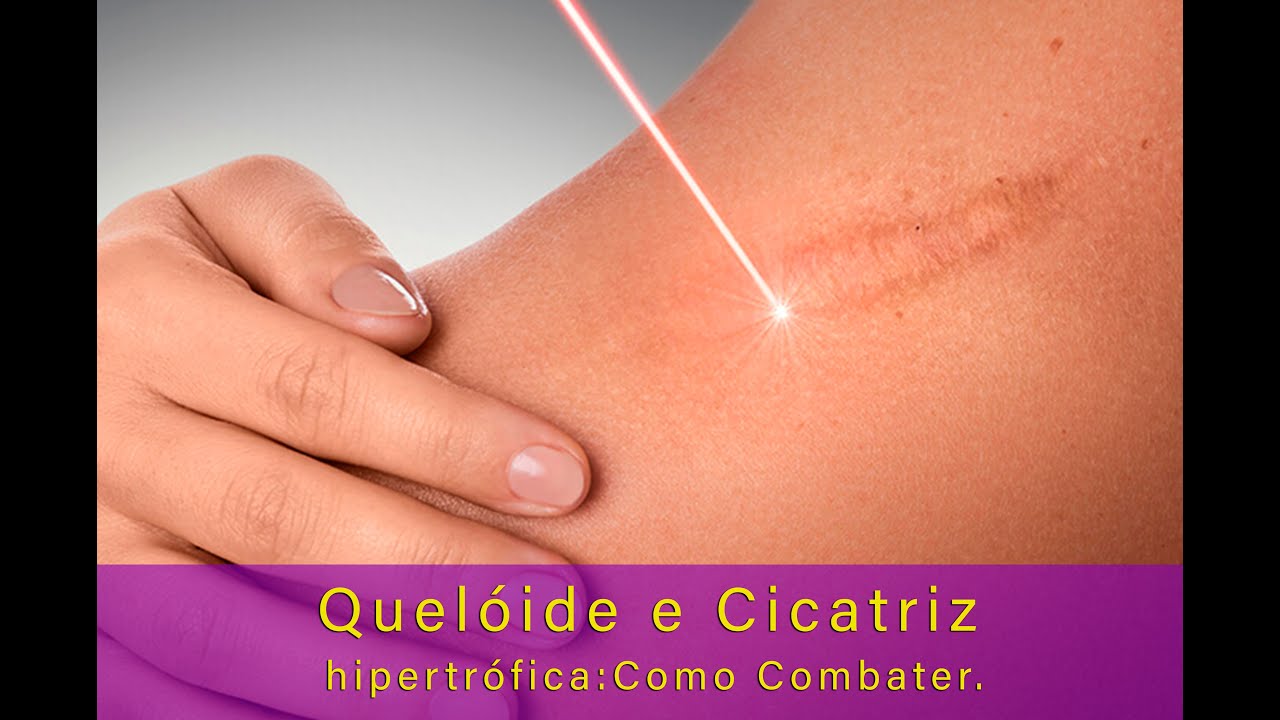 Quelóide e cicatriz hipertrófica: como combater