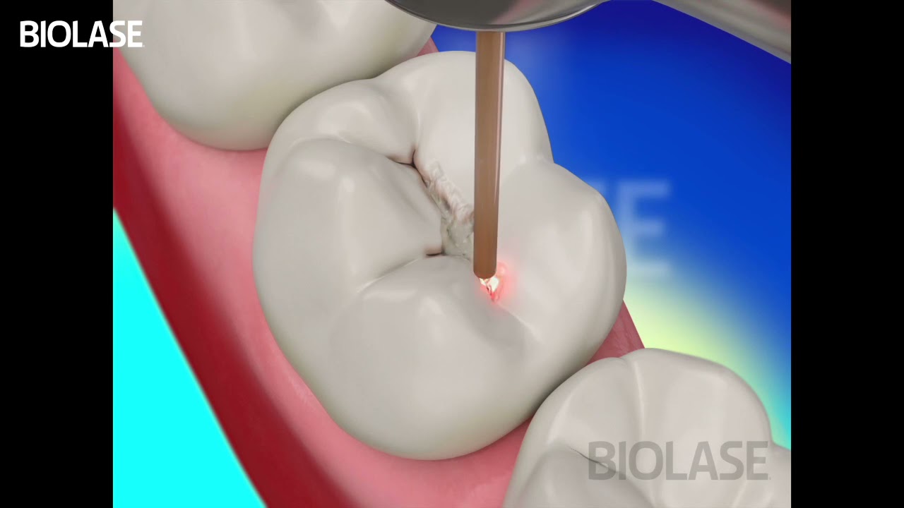 Carie Dentara Dinte de Lapte Clasa 1 cu Laserul Stomatologic Biolase