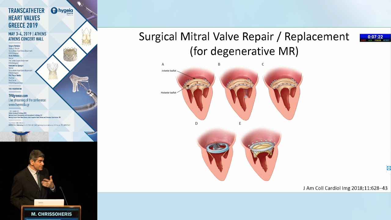M. Chrissoheris | Echocardiographic evaluation of the mitral valve.