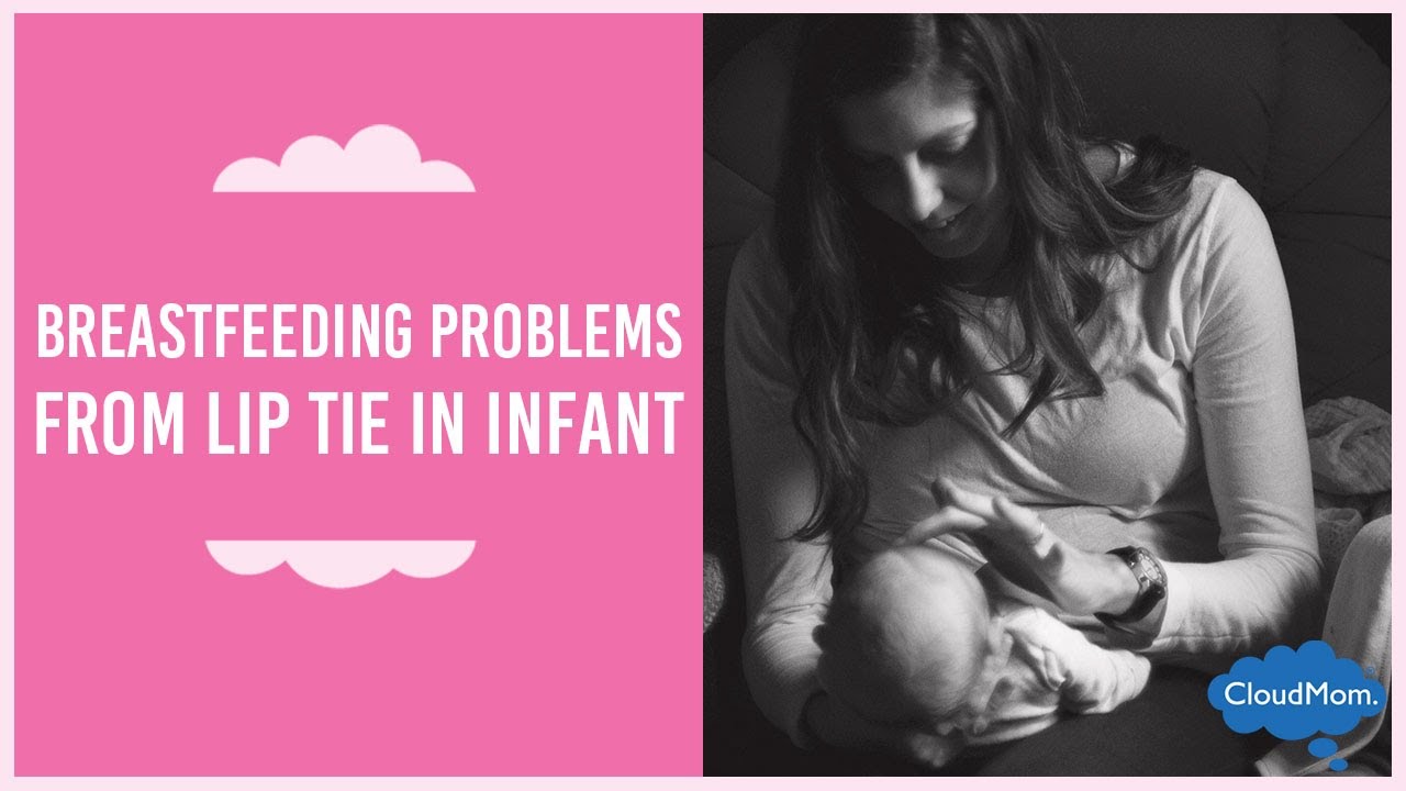Breastfeeding Problems from Lip Tie in Infant | CloudMom