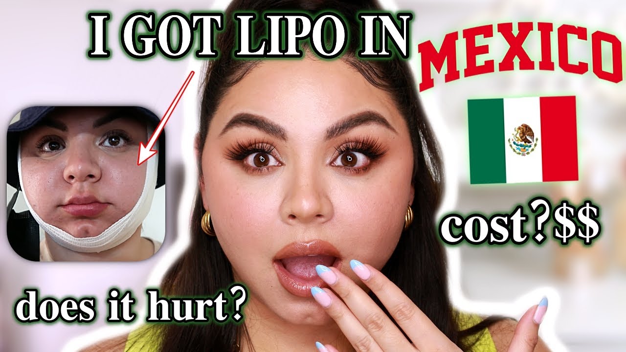 I Got Chin Lipo Surgery in Mexico My Experience Daily Updates 2 Weeks Results